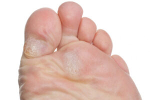 Calli ai piedi podoactiva