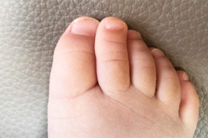 clinodattilia piede infantile